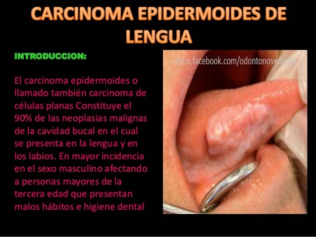 carcinoma epidermoide en lengua